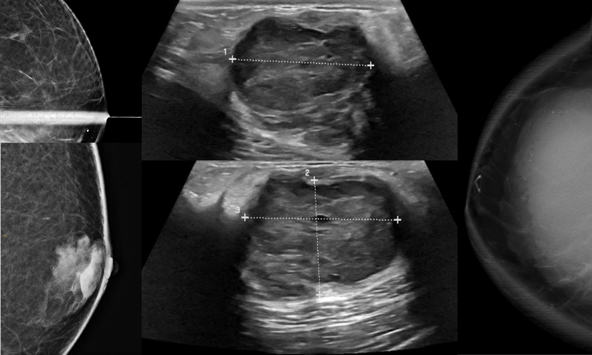 Breast Cancer Awareness Month: Interesting cases from RP radiologists