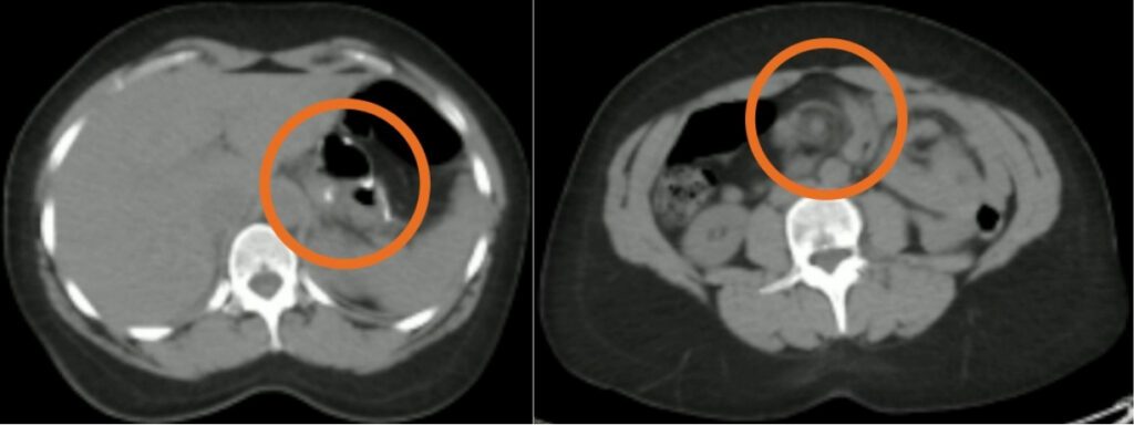 Distinctive mesenteric vessel "swirl" visible with postoperative volvulus.