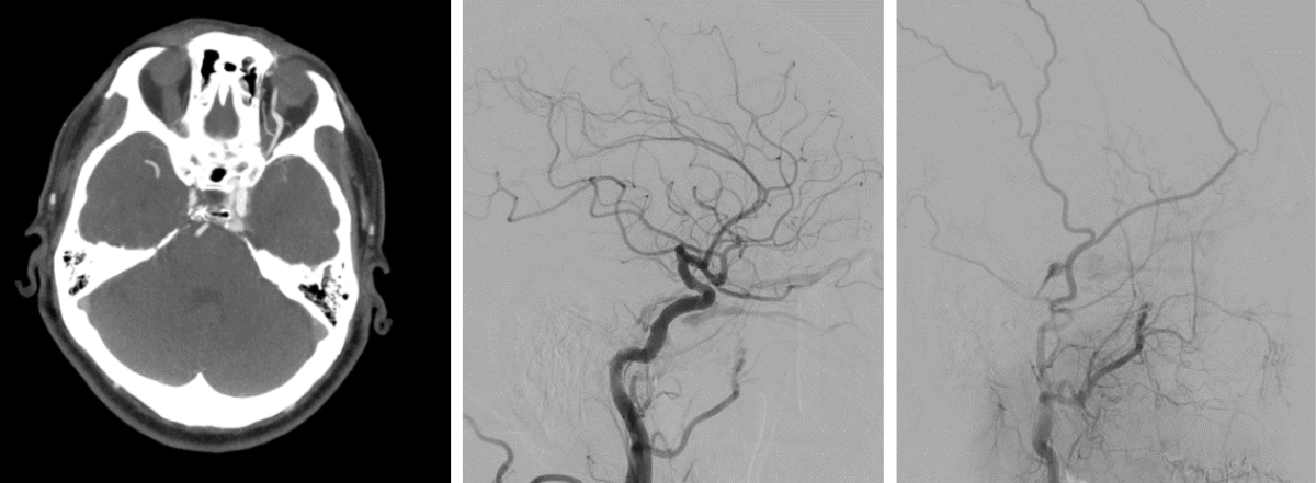 MRI scan of the brain showing Asymmetric enhancement of left cavernous sinus and dilated left superior and inferior ophthalmic veins in arterial phase. 