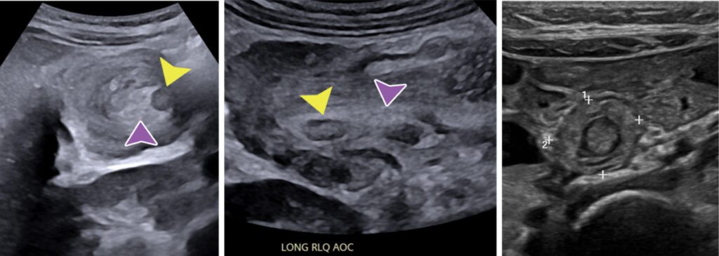Images 1 & 2: (purple arrow)Mesenteric fat and (yellow arrow) lymph node inside ileocolic intussusception. Small bowel intussusception.