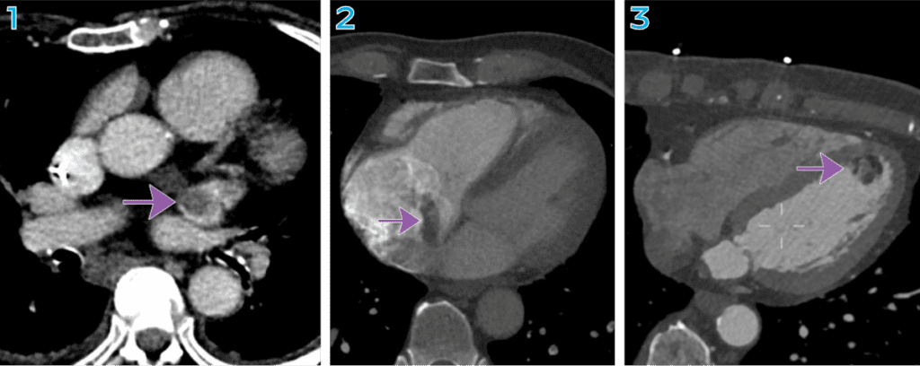 CT of the heart showing cardiac lesions.