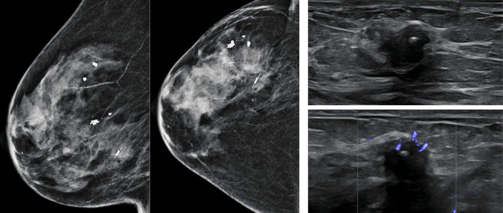 Post biopsy reflector, Right breast 7:00