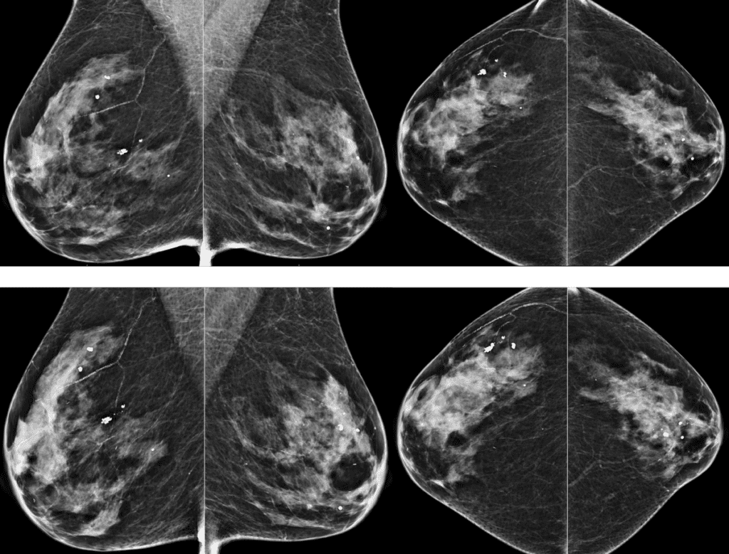 Breast Screening 2021, breast screening 2024
