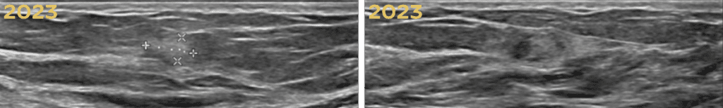 2023 mammogram palpable mass misdiagnosed as fat necrosis
