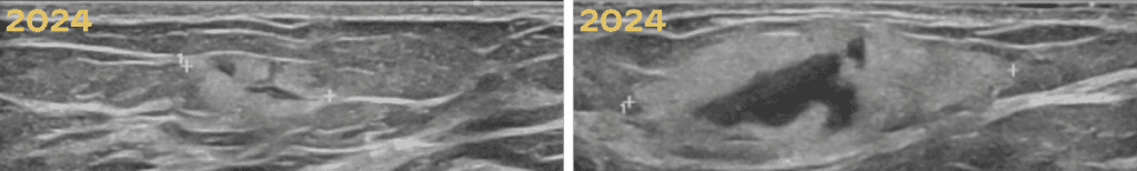 2024 mammogram palpable mass misdiagnosed as hematoma