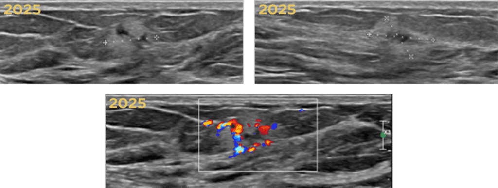 Mammogram of biopsy-proven invasive lobular carcinoma