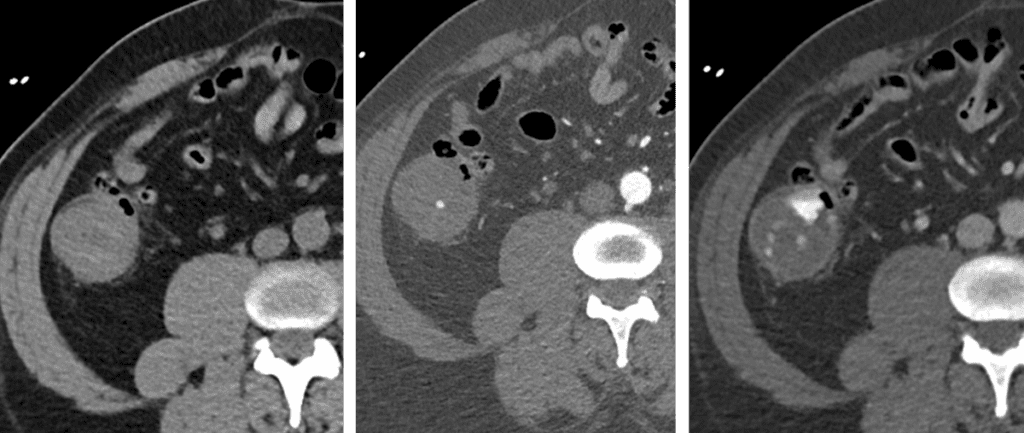Active GI Bleed on CTA