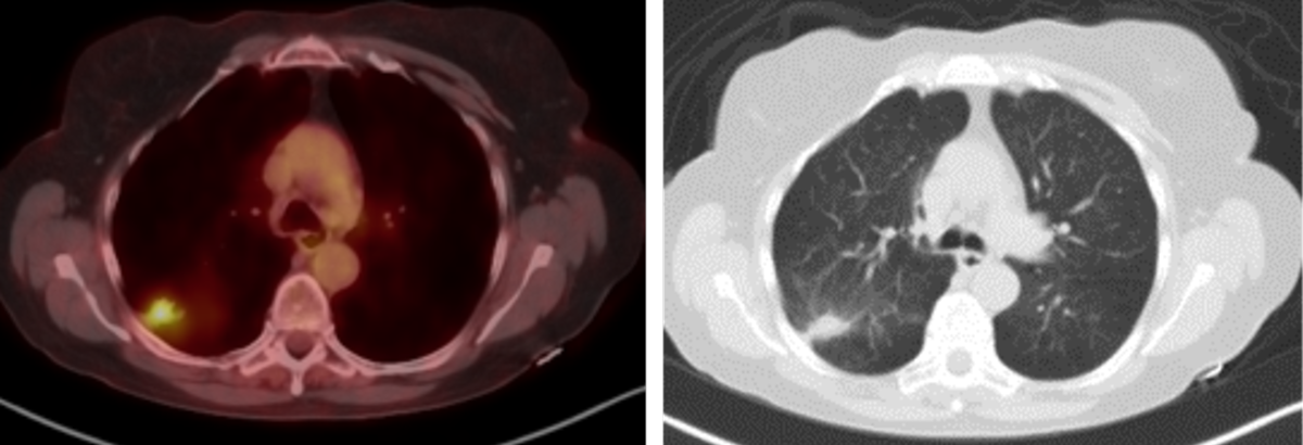 2020 study- Biopsy-proved adenocarcinoma. SUV Max 5.4