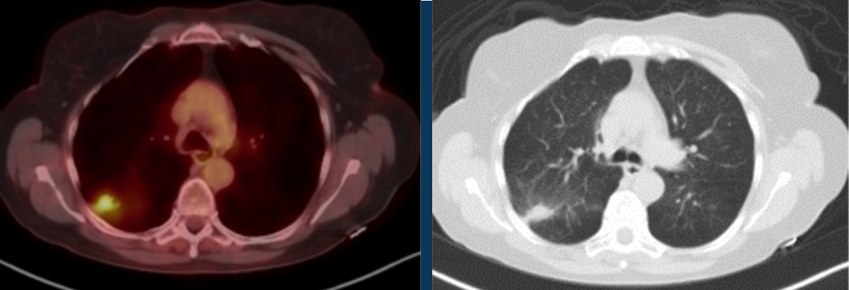 Low-level FDG uptake in a solid pulmonary nodule does not exclude malignancy. 2018 study - “below threshold SUV”