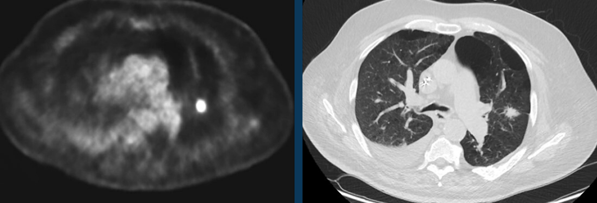 Subsolid Pulmonary Nodules on FDG PET/CT