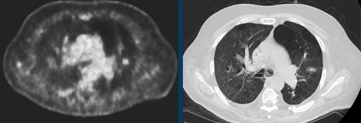 Low-level FDG uptake in a subsolid pulmonary nodule does not exclude malignancy.
