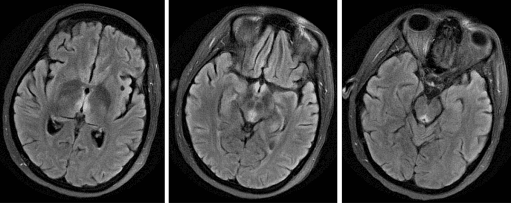 MRI scan showing 3 different views of a patient's brain.