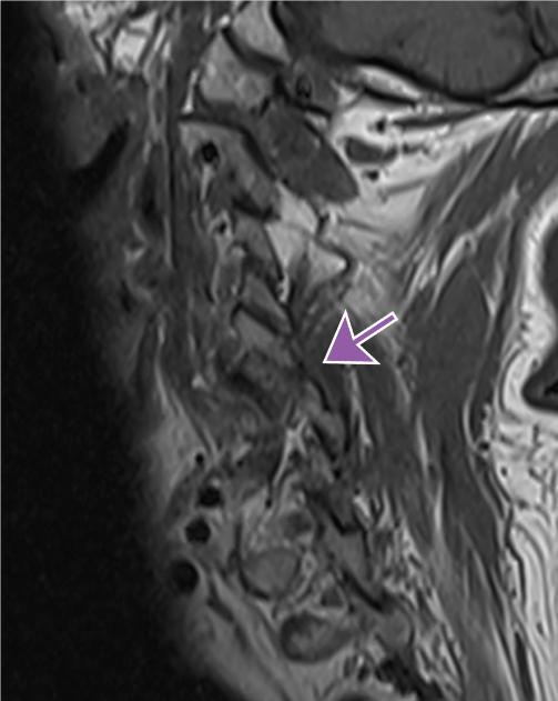 radiographic image of spine with an arrow pointing to an area