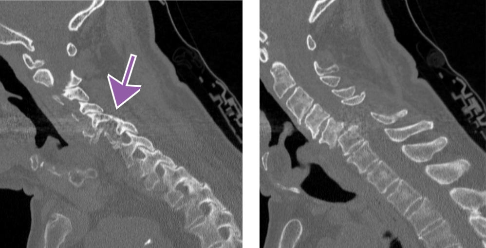 radiographic image of a spinal with malalignment of the facet joints.