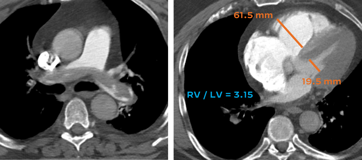 Measure perpendicular to the long axis of the heart