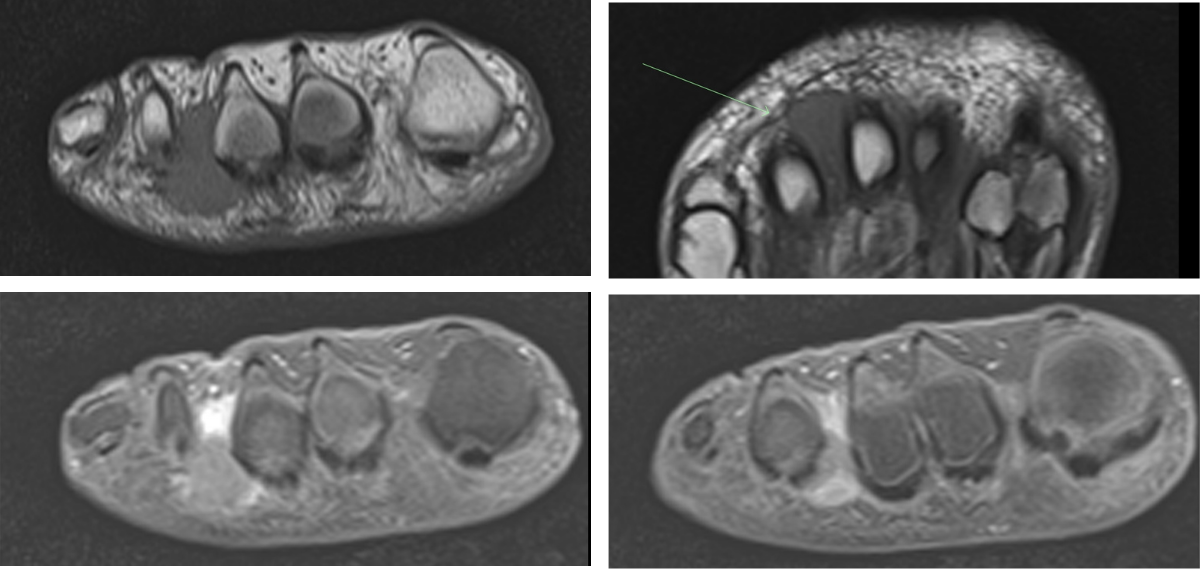Moron's Neuroma radiographic image