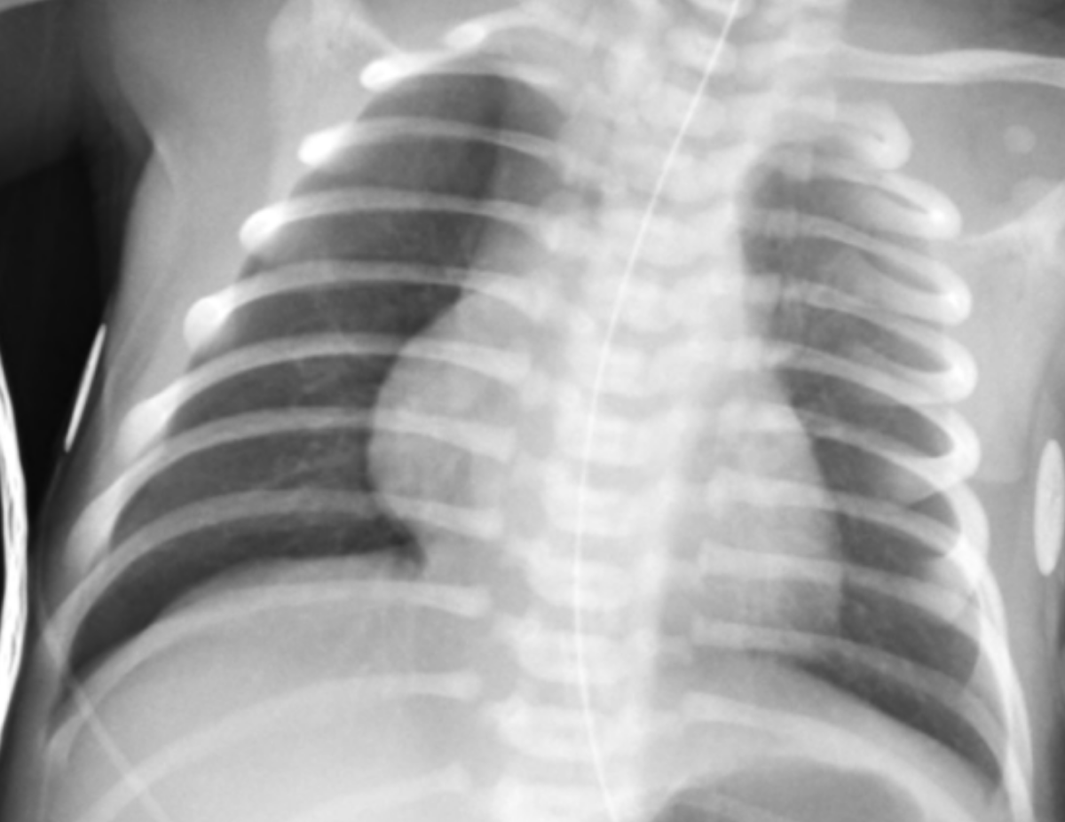 Pediatric chest radiograph