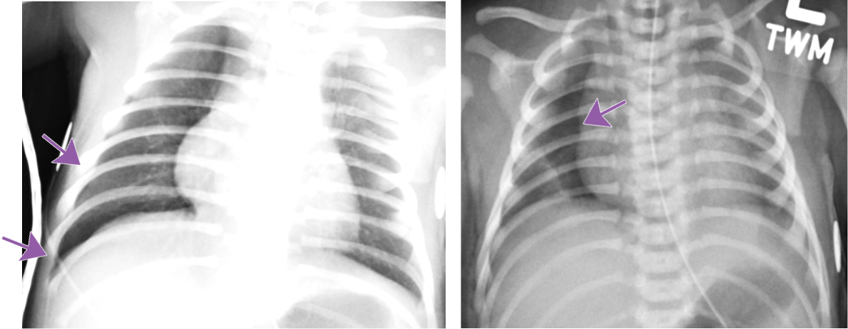 Pediatric chest radiograph showing anterior pneumothorax with arrow pointing to landmarks