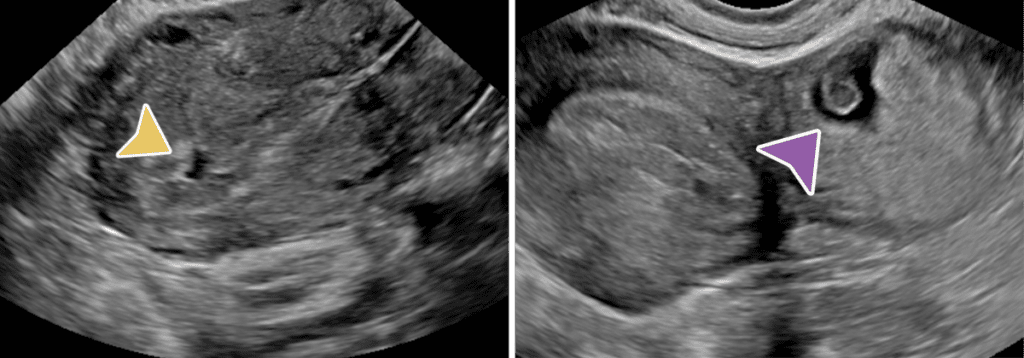 arrows pointing to different types of ectopic pregnancies