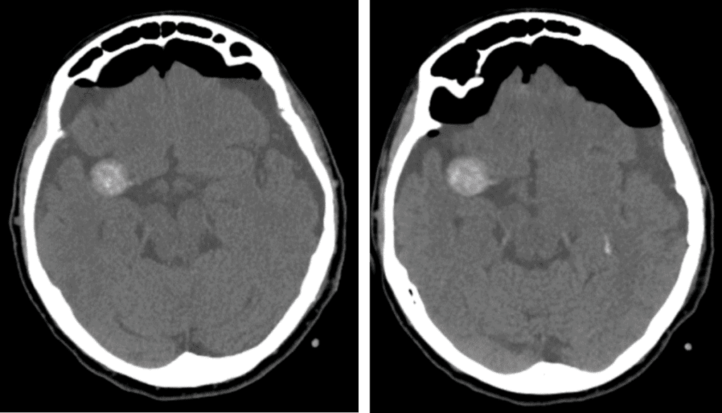 a ct scan of a tension pneumocephalus