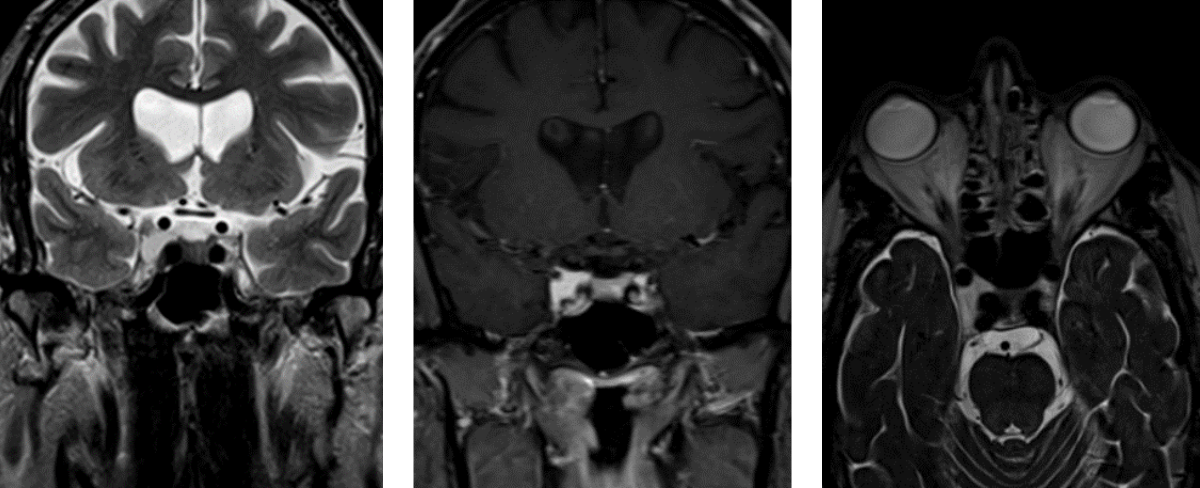 brain scan showing inoperative hemorrhage