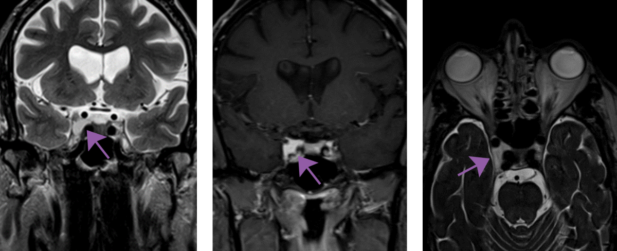 brain scan showing inoperative hemorrhage with arrows pointing to landmarks