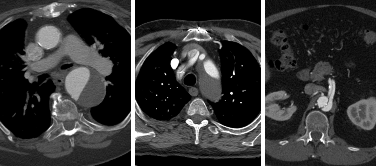 A set of three CT scan images showing cross-sectional views of the chest and abdomen, ideal for Rad to Rad Learning, featuring the heart, lungs, spine, aorta, and abdominal organs in grayscale.
