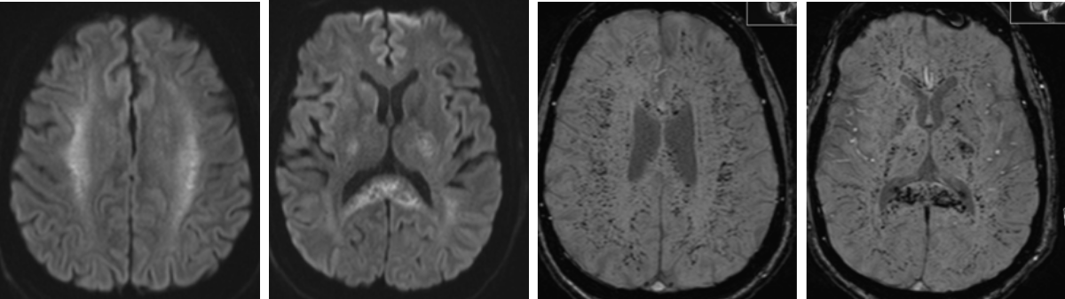 Four grayscale MRI brain scans, side by side, show cross-sectional views with varying contrasts and visible structures. Ideal for Rad to Rad Learning, the images highlight differences in brain tissue and potential abnormalities.