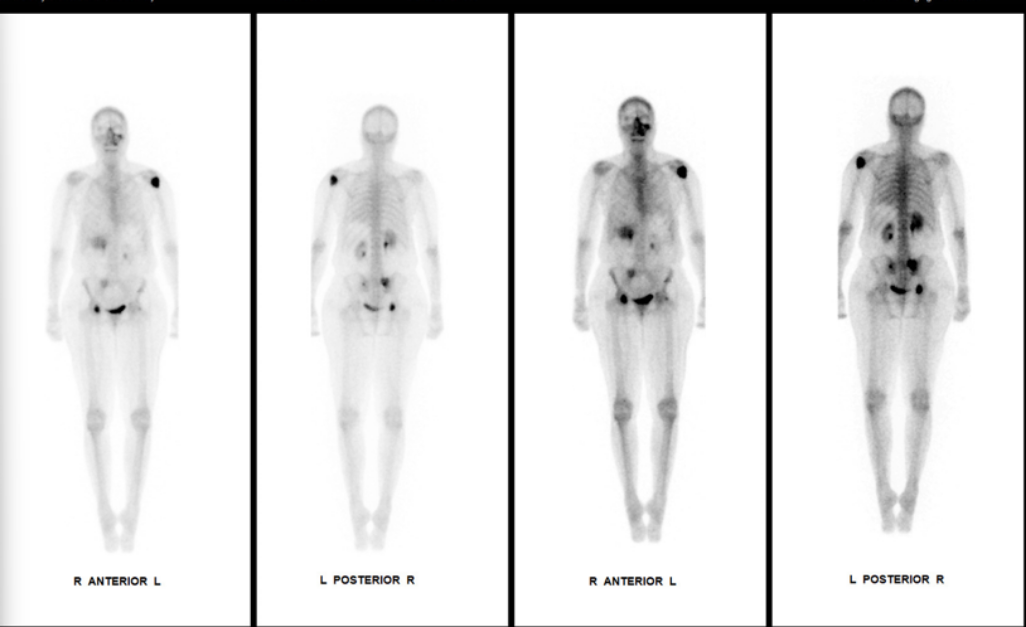 Four whole-body bone scan images in black and white, showing anterior and posterior views of two individuals. Labeled right and left sides enhance orientation—ideal for Rad to Rad Learning sessions.