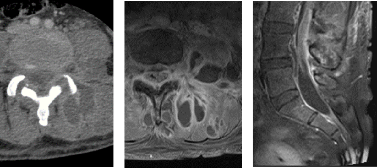 Three medical images: a CT scan (left), an axial MRI (center), and a sagittal MRI (right) of the lumbar spine, showing different views of spinal anatomy and structures—ideal for Rad to Rad Learning and comparative radiology education.