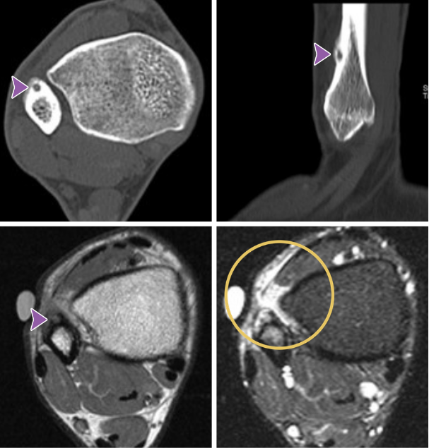 Four medical scans of a limb, ideal for Rad to Rad Learning, show a small circular lesion marked by arrows and a circle, highlighting an abnormal area near a bone, likely for diagnostic purposes.