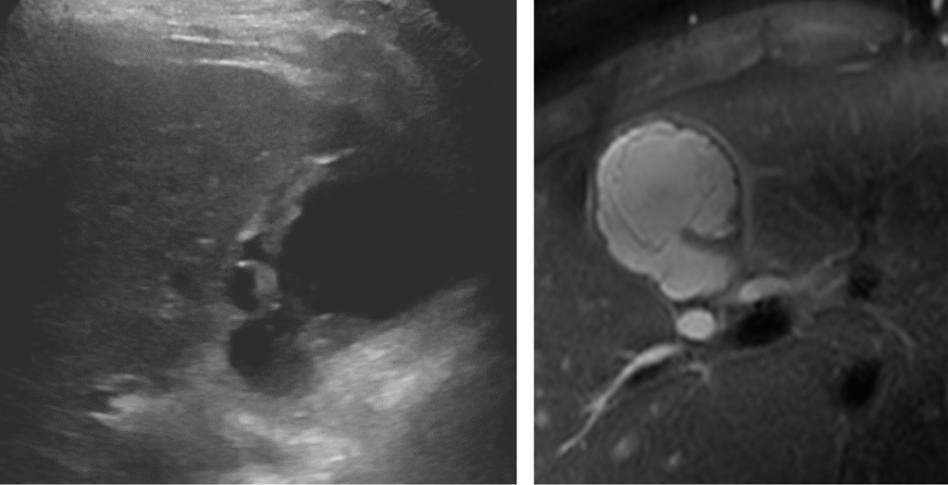 Side-by-side medical images: left is an ultrasound showing a dark, round mass; right is an MRI with a bright, circular structure near the spine, possibly showing an abdominal aortic aneurysm. This comparative Rad to Rad Learning approach enhances diagnostic understanding by juxtaposing key imaging findings across modalities.