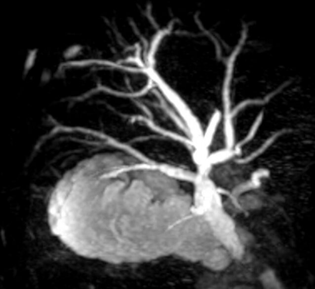 Black and white medical scan showing the liver and branching bile ducts, likely an MRI or CT image used for diagnosing liver or biliary conditions—ideal for Rad to Rad Learning, where detailed imaging is essential for case-based education and discussion.