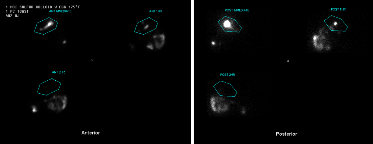 Nuclear medicine scan showing anterior and posterior views with highlighted regions labeled ANT MEDLINE, ANT HR, ANT 3HR, POST MEDLINE, POST HR, and POST 3HR in blue outlines.