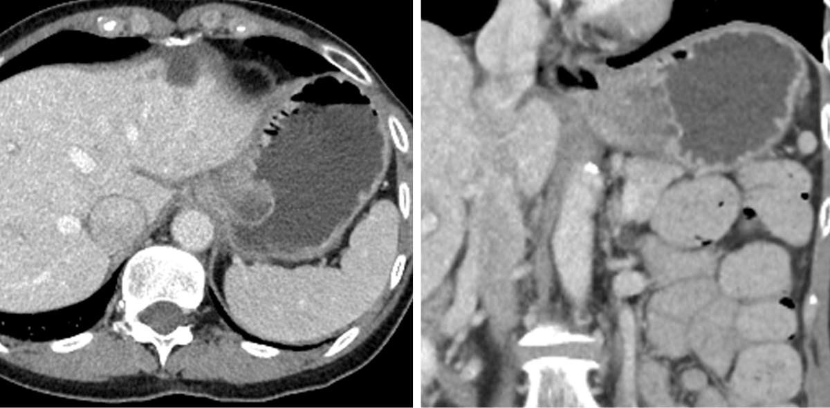 CT scans showing a large mass in the upper abdomen, likely originating from the spleen, with clear borders and different densities compared to surrounding tissues. One image is axial, the other coronal—ideal for Rad to Rad Learning and collaborative case discussions.