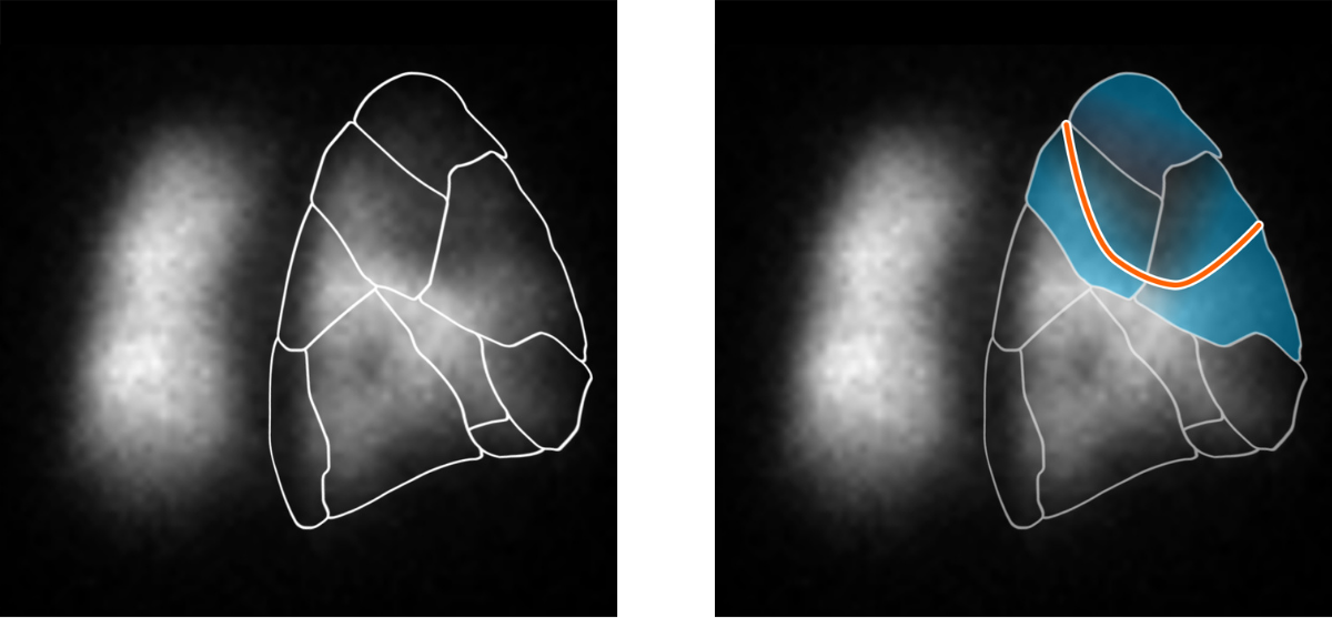 Two grayscale images of a lung scan: the left image shows lung regions outlined in white, while the right highlights the upper-right lung region in blue with an orange border, demonstrating detailed focus on that area as part of Rad to Rad Learning.