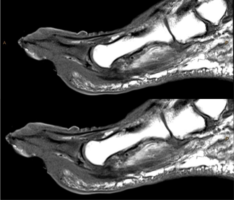 T1 signal is darker than muscle (marrow replacement).