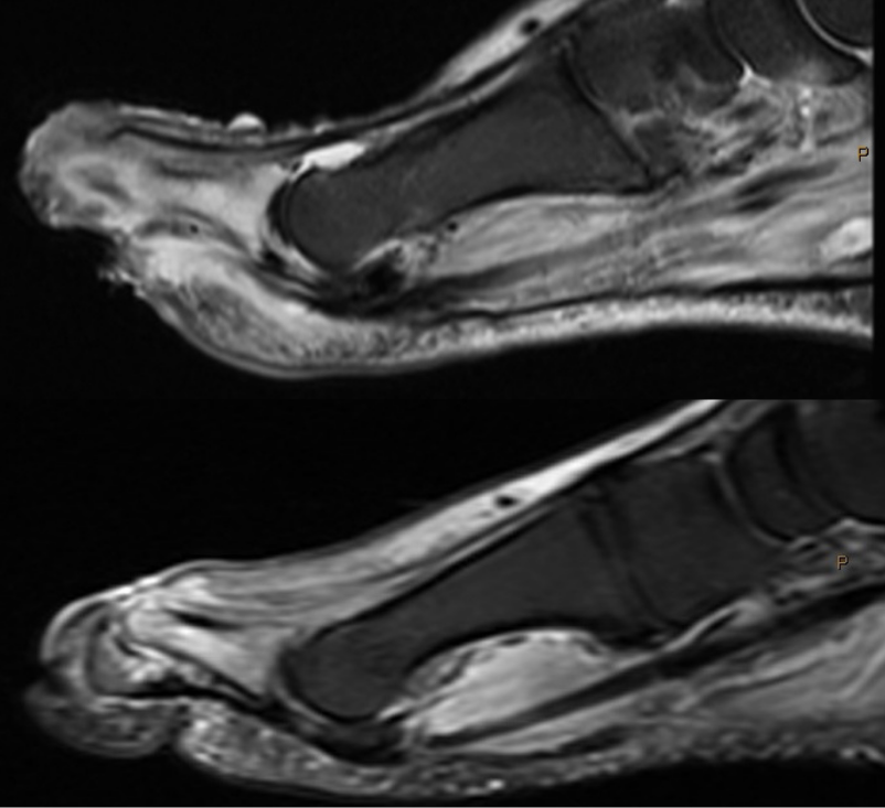 T2 edema signal.