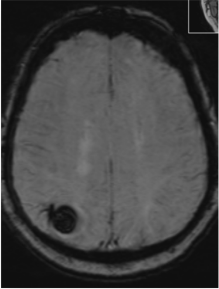 Axial MRI brain scan showing a circular, dark lesion near the left posterior region, possibly indicating a mass or abnormality—an ideal case for Rad to Rad Learning and collaborative diagnostic review.