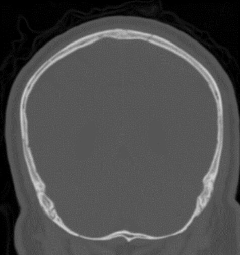A grayscale scan of a human skull viewed from the front, showing the outline of the skull and cranial cavity with no visible internal detail or abnormalities—a valuable example for Rad to Rad Learning in radiographic interpretation.