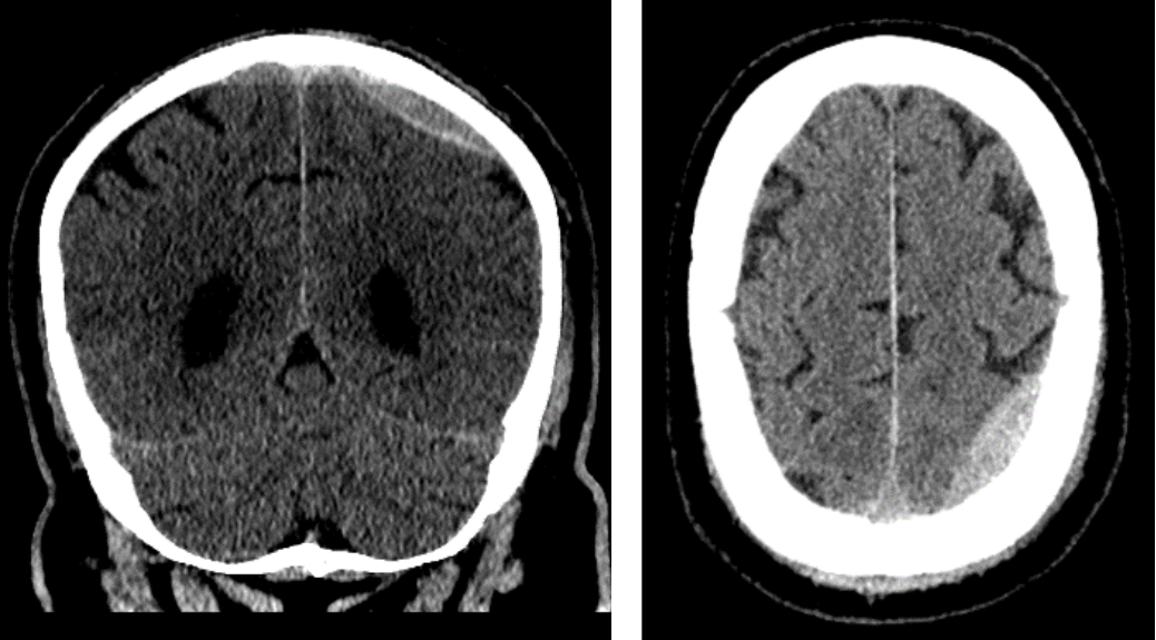 Two CT brain scans: the left shows a front-facing (coronal) view, and the right shows a horizontal (axial) view, both revealing brain structures in grayscale with bone shown in white—an ideal example for Rad to Rad Learning.